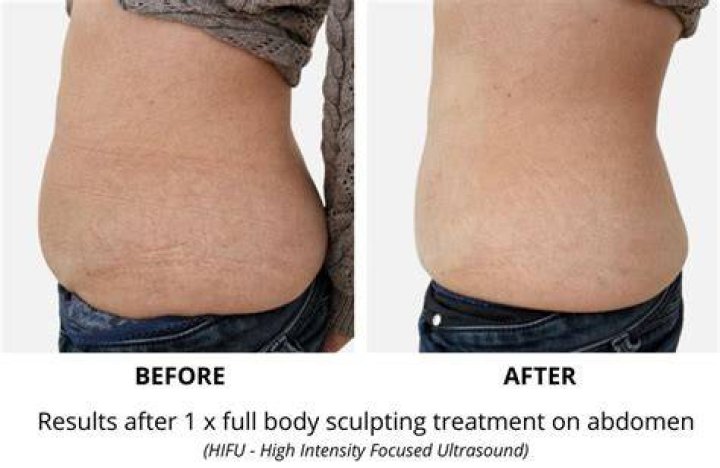 How Does Body Sculpting Actually Work?