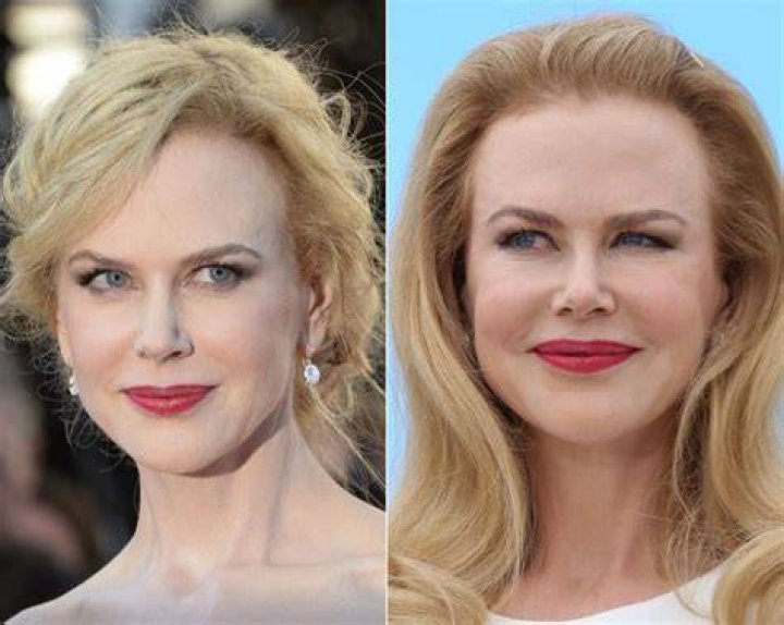 Nicole Kidman Plastic Surgery Before After Pics